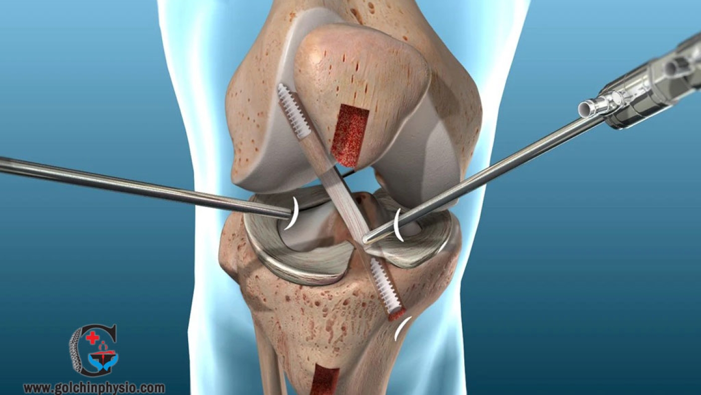 فیزیوتراپی بعد از عمل جراحی (تعویض مفصل، ACL) در هروی
